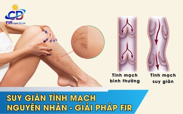 Suy Giãn Tĩnh Mạch – Nguyên Nhân, Triệu Chứng & Cách Hỗ Trợ Bằng Hồng Ngoại Xa