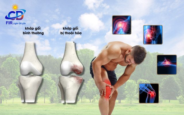 Thoái Hóa Khớp Gối – Nguyên Nhân, Triệu Chứng & Giải Pháp Bằng Công Nghệ Nano Bán Dẫn FIR