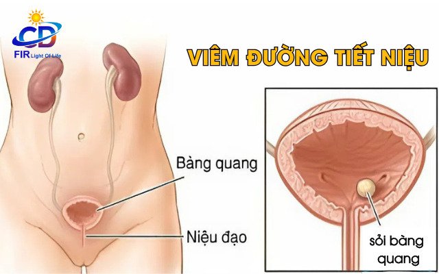 Viêm Đường Tiết Niệu – Nguyên Nhân, Triệu Chứng & Giải Pháp Hỗ Trợ Bằng FIR