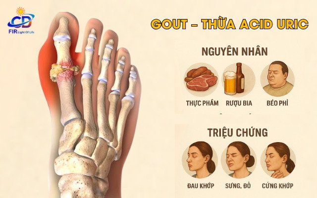 Gout – Thừa Acid Uric: Nguyên Nhân, Triệu Chứng & Giải Pháp Hỗ Trợ Bằng Công Nghệ Nano Bán Dẫn FIR
