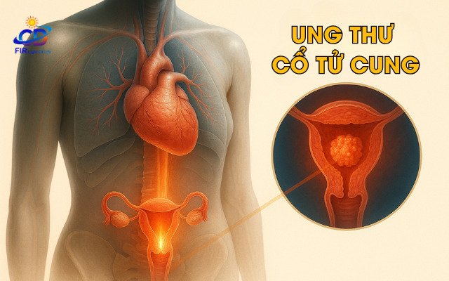 Ung Thư Cổ Tử Cung – Nguyên Nhân, Dấu Hiệu Sớm & Giải Pháp Hỗ Trợ Bằng FIR