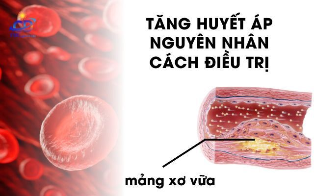 Huyết Áp Cao – Nguyên Nhân, Nguy Cơ & Cách Hỗ Trợ Ổn Định Bằng Hồng Ngoại Xa