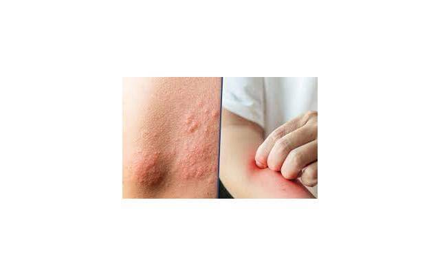 Viêm Da Cơ Địa – Nguyên Nhân, Hậu Quả & Giải Pháp Hỗ Trợ Bằng Hồng Ngoại Xa