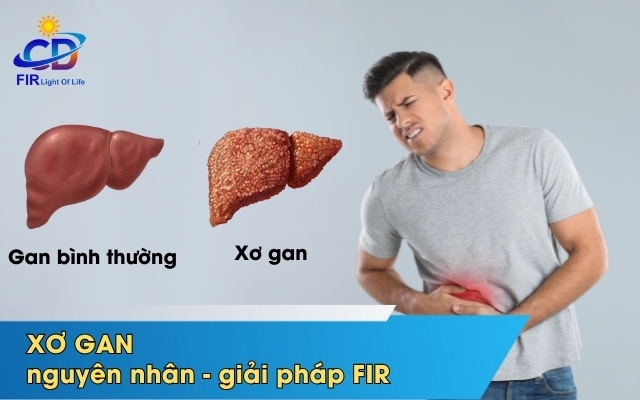 XƠ GAN NGUYÊN NHÂN, TRIỆU CHỨNG VÀ GIẢI PHÁP HỖ TRỢ