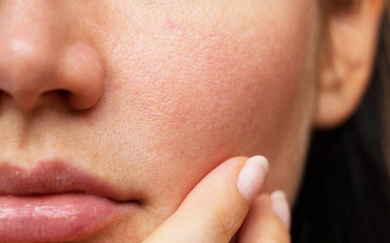 Tổng quan về da khô - đặc điểm và cách chăm sóc da khô