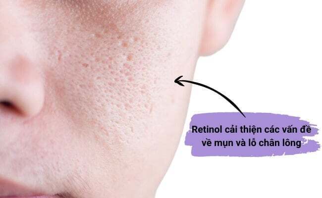 dermtalk-retinol-la-gi-2