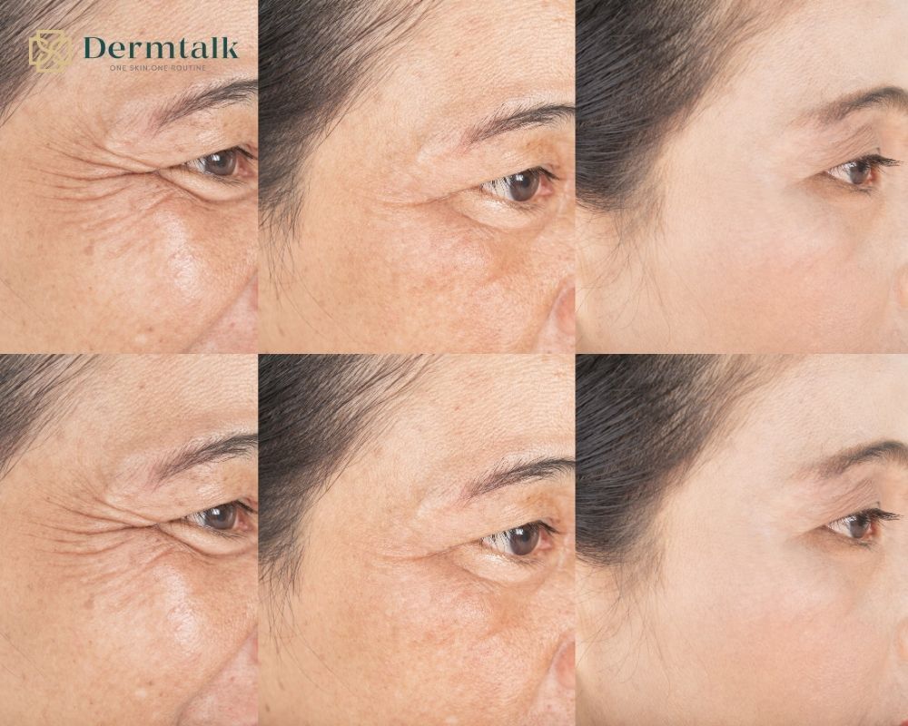 tai-sao-nen-dung-serum-xoa-nep-nhan-cang-som-cang-tot